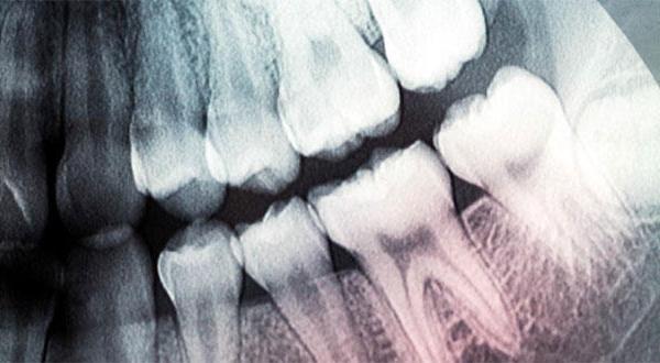 teeth-regrow-laser-31052014-002