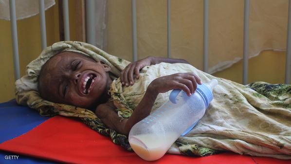 SOMALIA-MALNUTRITION